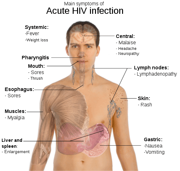 Aids Hiv Symptoms Men